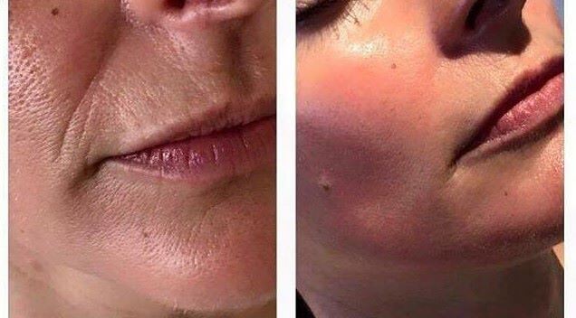 The Beauty Gun - de nieuwste techniek voor huidverjonging?