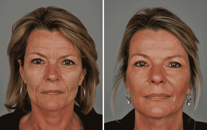 ingevallen wangen Afbeelding