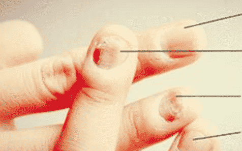 Wat vertelt de staat van je nagels je over je gezondheid? Afbeelding