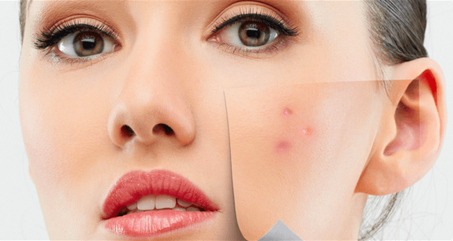 Natuurlijke middeltjes in de strijd tegen acne