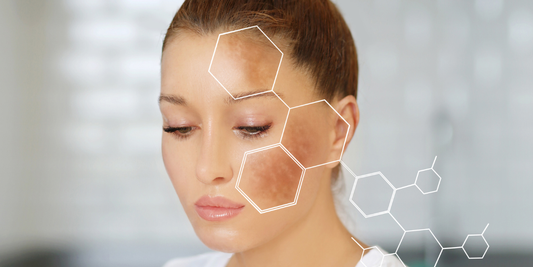 vrouw met hyperpigmentatie in het gezicht