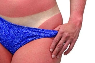 Tips tegen zonnebrand