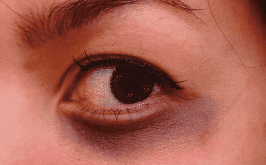 donkere kringen en wallen onder de ogen