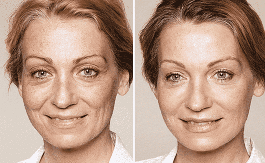 Hoe kan je wallen snel en gemakkelijk weg werken?