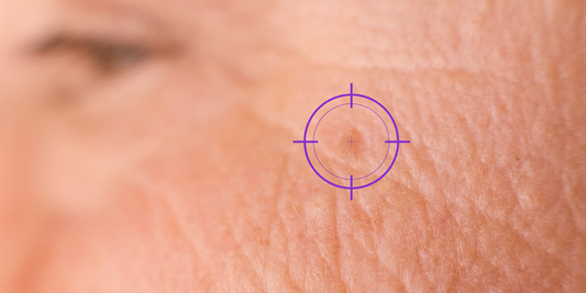 vervormde pigmentvlek op een verouderde huid